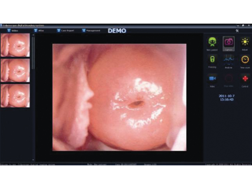 Colposcopy SOFTWARE for 29624. 29625