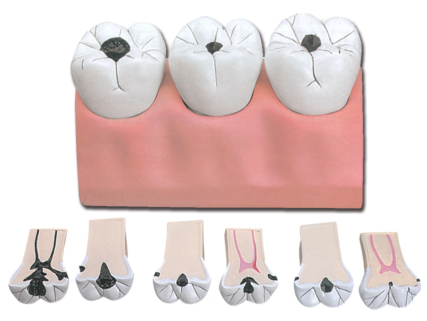 Modeļi -cilvēka anatomija, Dental CARIES - 7 parts - 4x