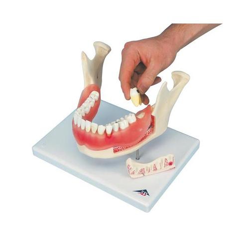 018Dental disease, magnified 2 times, 21 parts