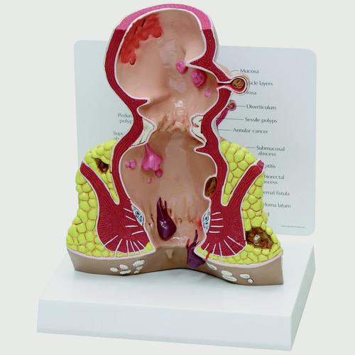 016Rectum cross section (oversize) with pathologies