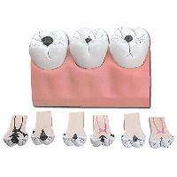 Dental CARIES - 7 parts - 4x