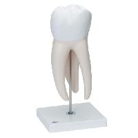Giant Molar with Dental Cavities, 15 times life size, 5 part