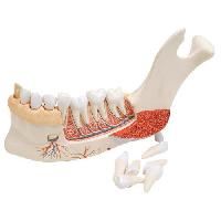 Advanced Half Lower Jaw with 8 diseased teeth, 19 part