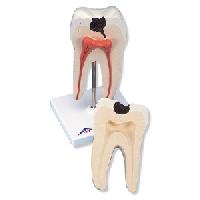 Lower Twin-Root Molar showing cavities, 2 part
