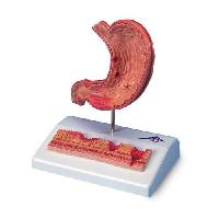 Stomach with Ulcers