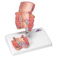 Hemorrhoid Model