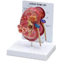 Diseased Kidney Model